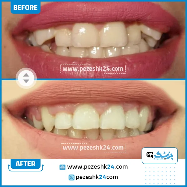 قبل و بعد ارتودنسی دکتر محسن تهمتن شیراز