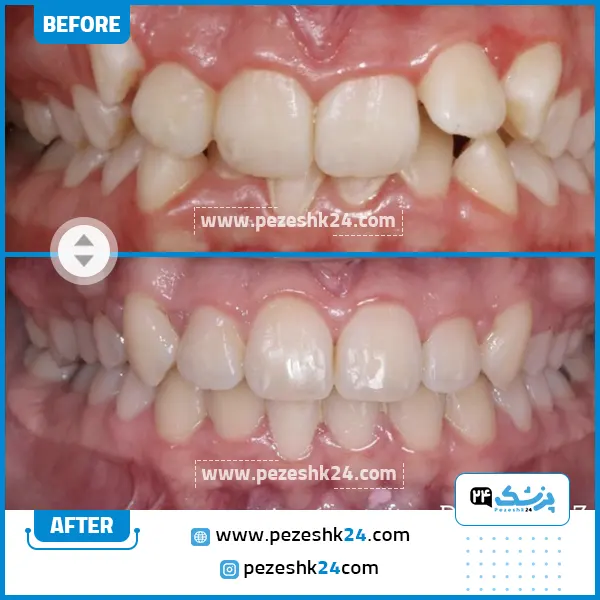قبل و بعد ارتودنسی دندان دکتر ظریف شیراز