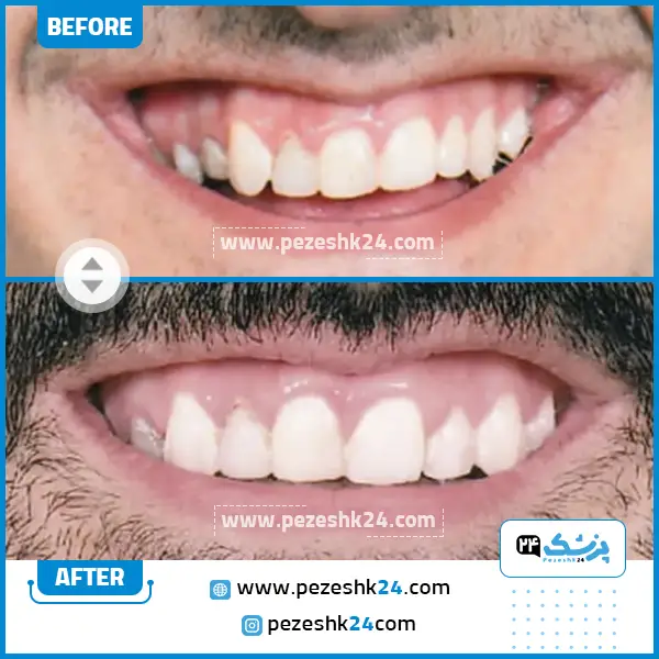 قبل و بعد ارتودنسی دندان دکتر ظریف