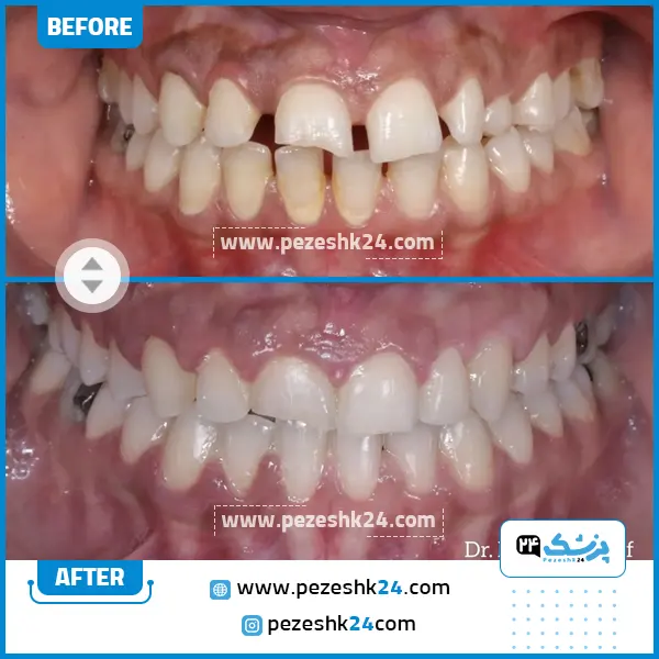قبل و بعد ارتودنسی دندان دکتر هومن ظریف