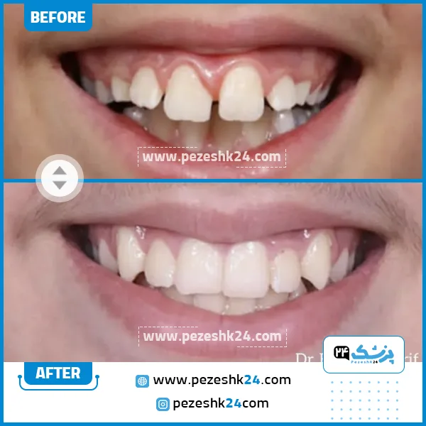 قبل و بعد ارتودنسی دکتر ظریف