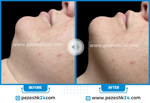 عمل زیبایی غبغب