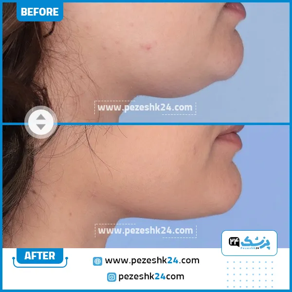 عمل جراحی غبغب