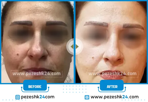 قبل و بعد میکرونیدلینگ صورت کلینیک سی زم