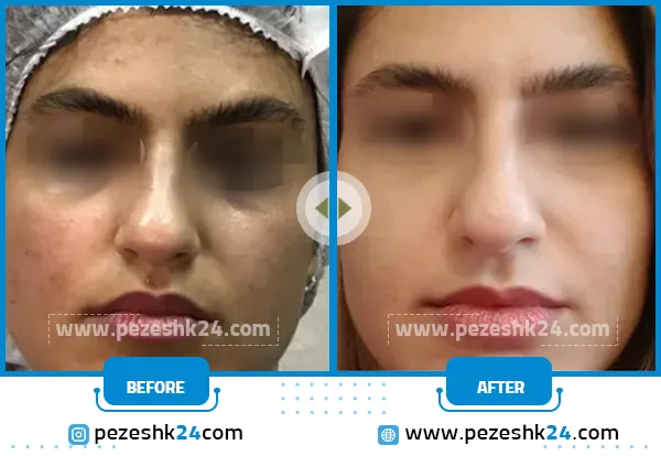 قبل و بعد میکرونیدلینگ صورت مرکز سی زم