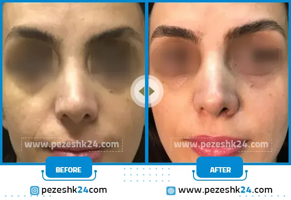 قبل و بعد میکرونیدلینگ کلینیک سی زم