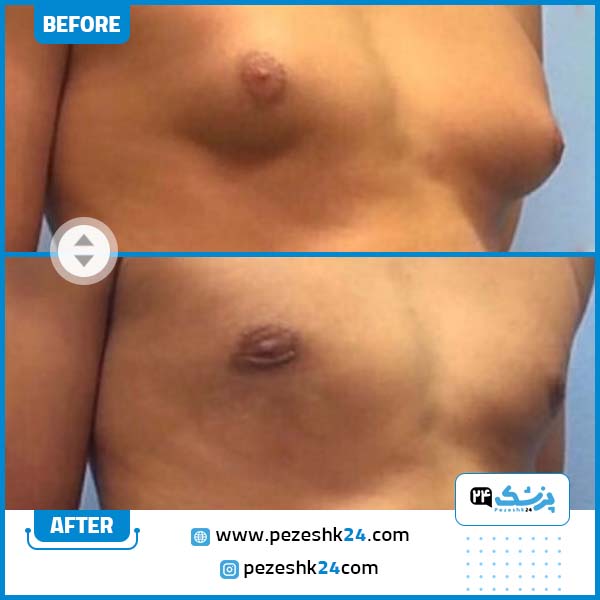 قبل و بعد جراحی ژنیکوماستی در مشهد