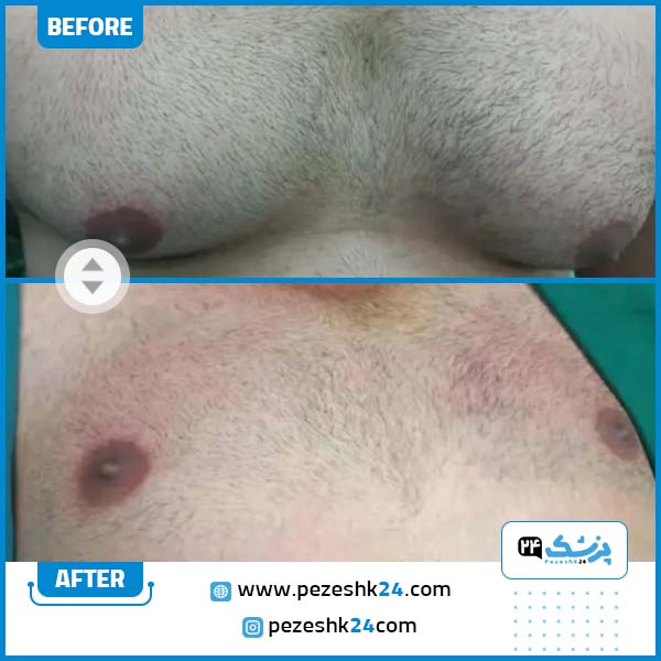 قبل و بعد جراحی ژنیکوماستی دکتر یوسفی
