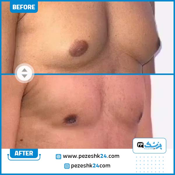 قبل و بعد جراحی ژنیکوماستی مشهد