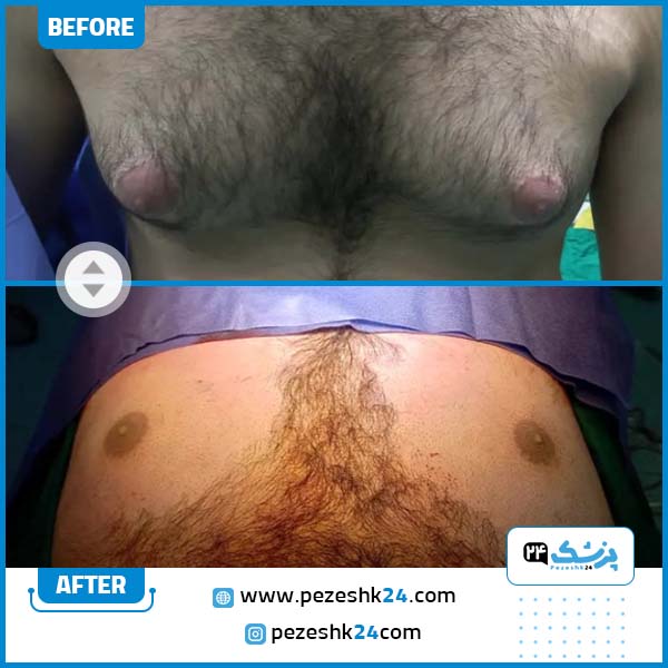 قبل و بعد از جراحی ژنیکوماستی دکتر یوسفی