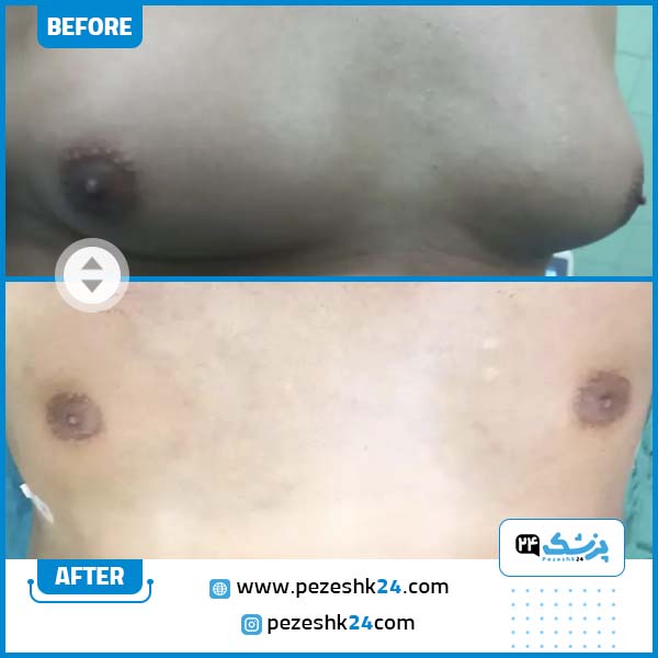 قبل و بعد عمل ژنیکوماستی دکتر یوسفی