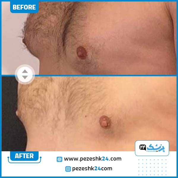 قبل و بعد از عمل ژنیکوماستی در مشهد