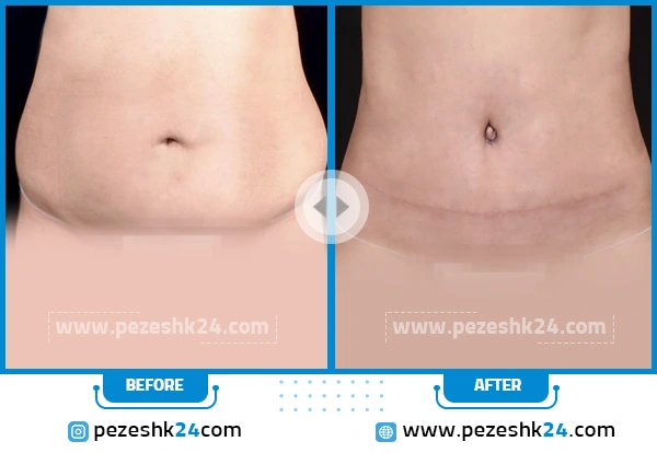 قبل و بعد لیپوماتیک شکم دکتر دریانی