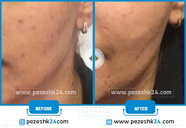 قبل و بعد میکرونیدلینگ صورت کلینیک موگه