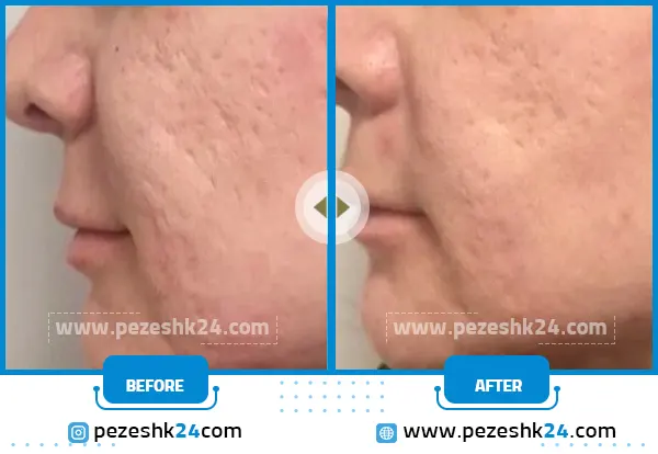 قبل و بعد میکرونیدلینگ صورت کلینیک موگه تهران