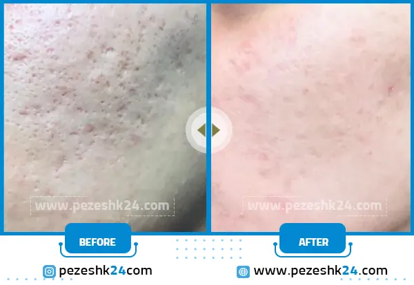 قبل و بعد میکرونیدلینگ صورت کلینیک موگه