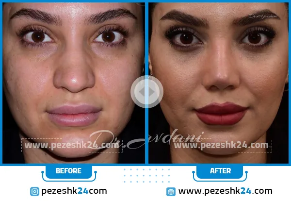 قبل و بعد عمل بینی گوشتی دکتر جاودانی تهران