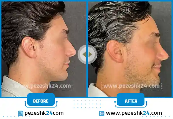 مدل بینی فانتزی طبیعی