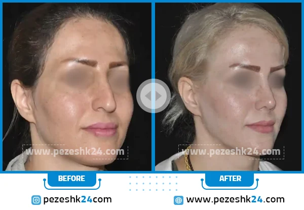 قبل و بعد عمل بینی دکتر غیاثی شیراز