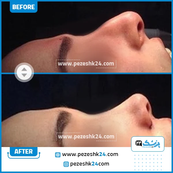 قبل و بعد عمل بینی دکتر موسی محمودی