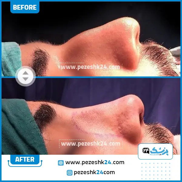 قبل و بعد عمل بینی دکتر محمودی