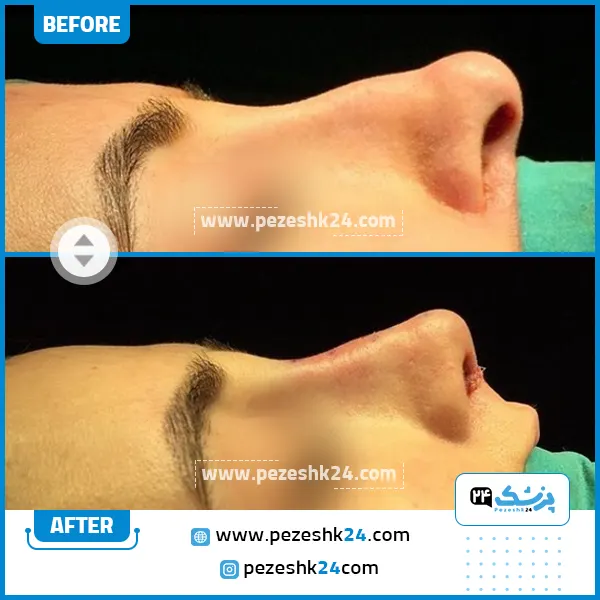 قبل و بعد جراحی بینی دکتر محمودی
