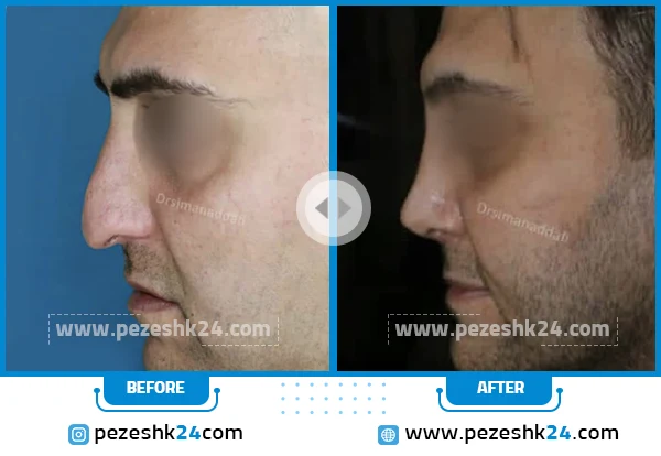 قبل و بعد عمل بینی دکتر ندافی