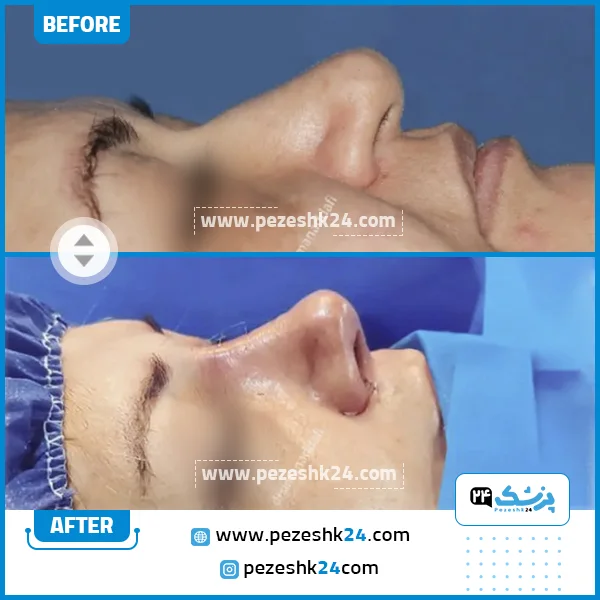 قبل و بعد جراحی بینی دکتر ندافی کرج