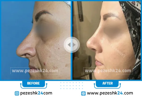 قبل و بعد عمل بینی دکتر ندافی کرج