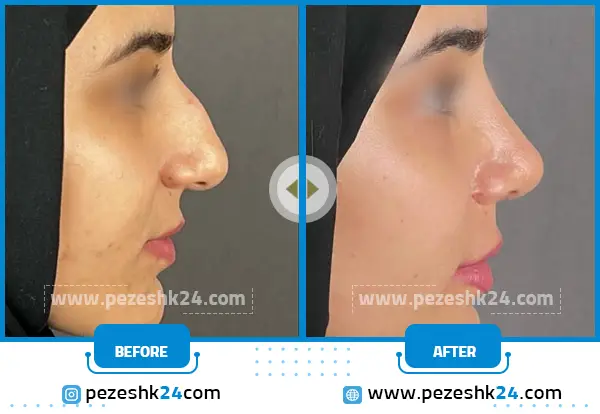 قبل و بعد عمل بینی طبیعی