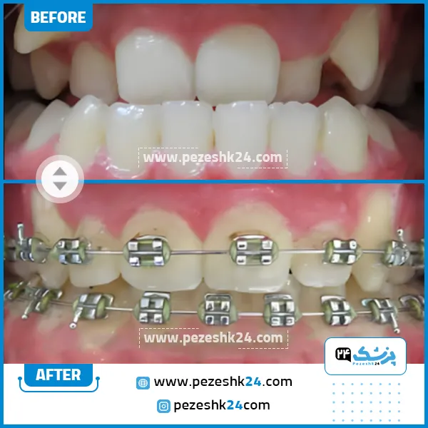قبل و بعد ارتودنسی دندان دکتر فاطمه زارع شیراز