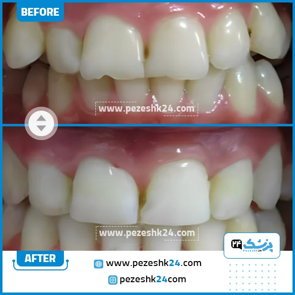 قبل و بعد ارتودنسی دندان دکتر فاطمه زارع