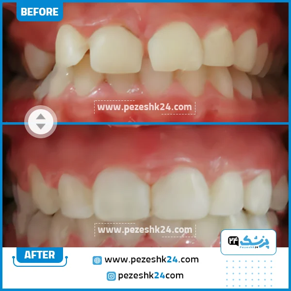 قبل و بعد ارتودنسی دندان دکتر زارع شیراز