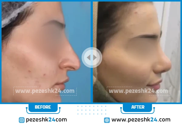 قبل و بعد عمل بینی دکتر عبدالمطلبی کرج