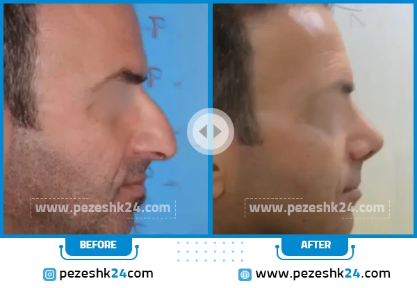 قبل و بعد جراحی بینی دکتر فرشته عبدالمطلبی