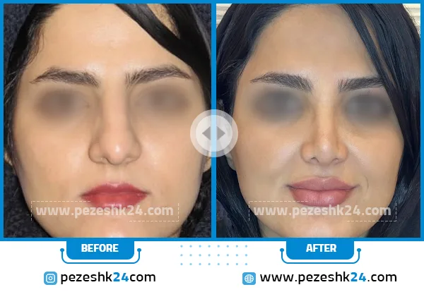 قبل و بعد عمل بینی دکتر حمیدرضا مفرد