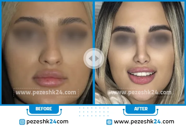 قبل و بعد عمل بینی دکتر مفرد