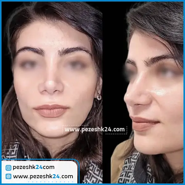 قبل و بعد عمل بینی دکتر حمیدرضا مفرد کرج