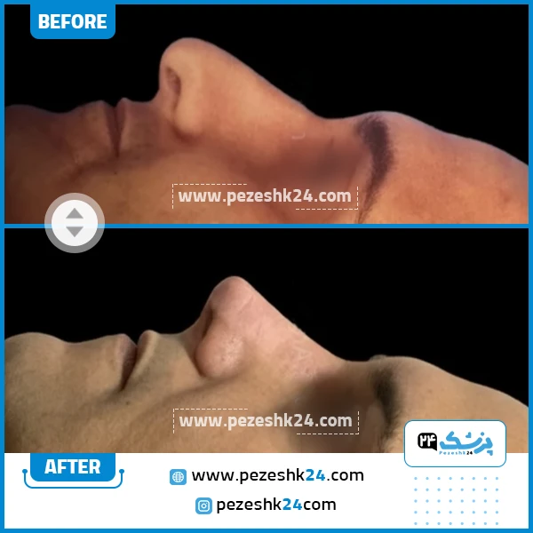 قبل و بعد عمل بینی دکتر سبحان منش