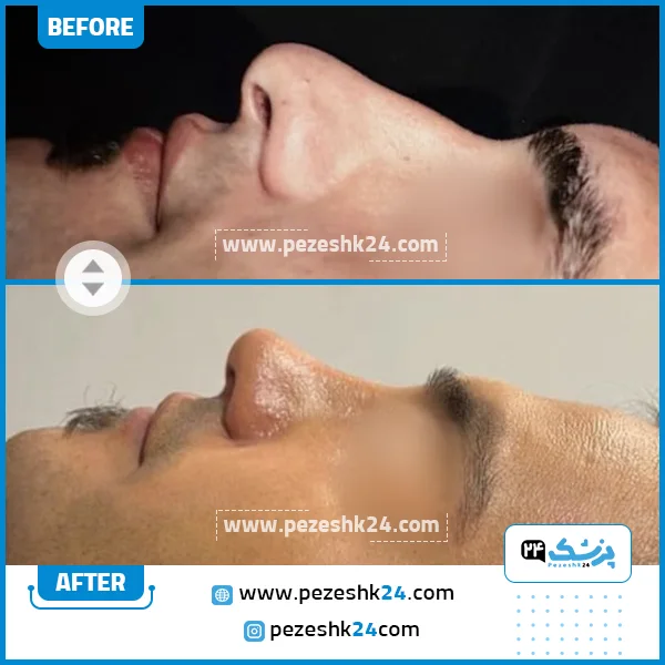 قبل و بعد جراحی زیبایی بینی دکتر سبحان منش