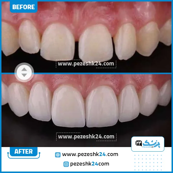قبل و بعد کامپوزیت دندان دکتر شیخی مشهد