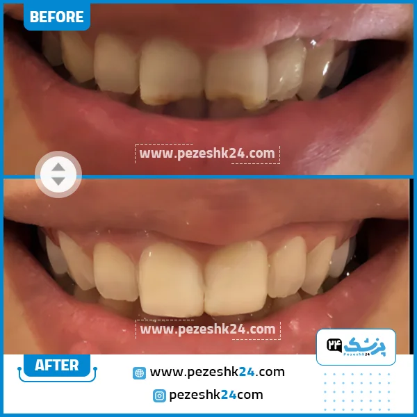 قبل و بعد کامپوزیت دندان دکتر شیخی
