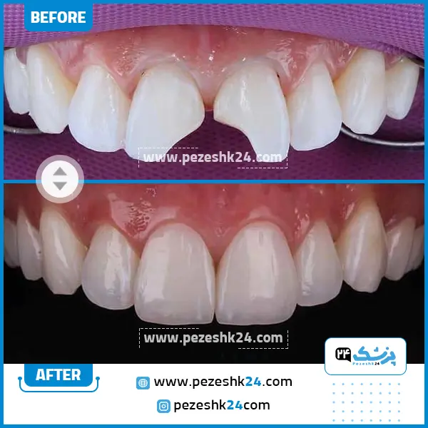 قبل و بعد کامپوزیت دندان دکتر جهانگیر شیخی