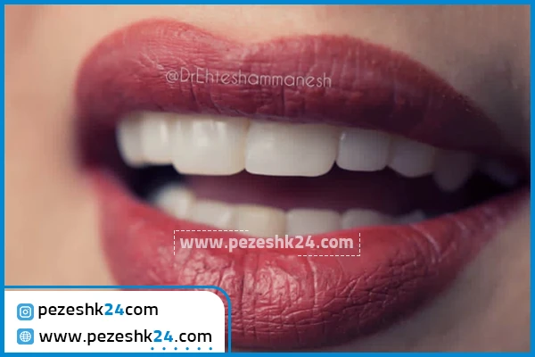 نمونه کامپوزیت دندان دکتر احتشام منش مشهد