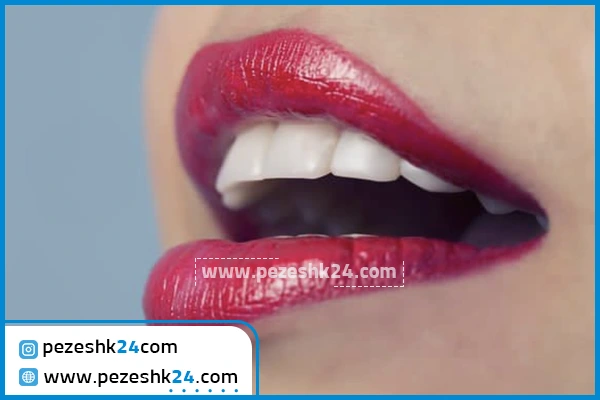 نمونه کامپوزیت دندان دکتر احتشام منش مشهد