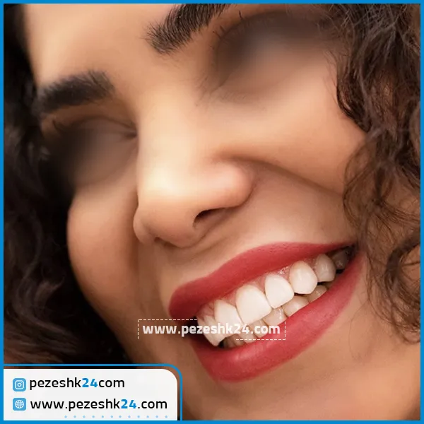 نمونه ونیر کامپوزیت دکتر احتشام منش