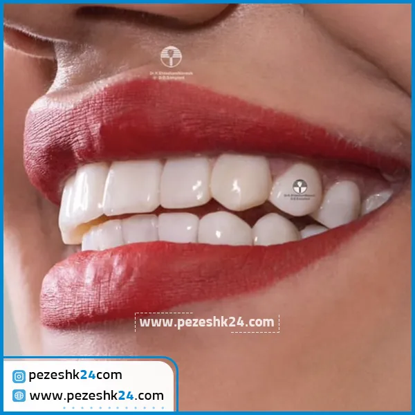 کامپوزیت دندان دکتر کاظم احتشام منش