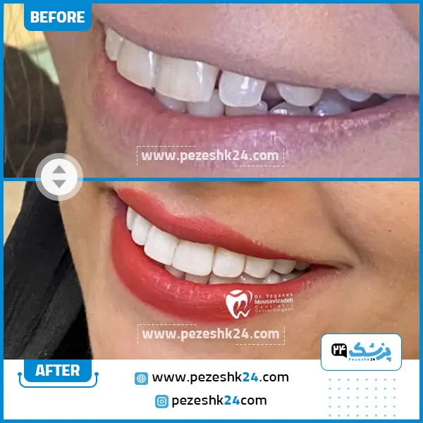 قبل و بعد کامپوزیت دندان دکتر یگانه موسوی زاده