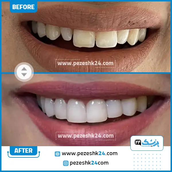 قبل و بعد کامپوزیت دکتر یگانه موسوی زاده