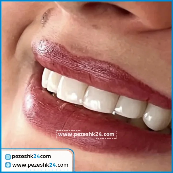 نمونه کامپوزیت دکتر موسوی زاده